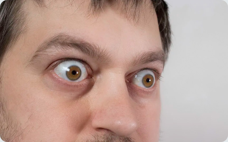 بیماری تیروئید چشمی یا گریوز