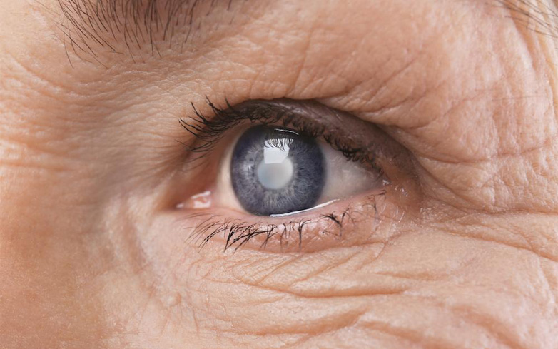 علت اصلی آب سیاه فشار غیرطبیعی چشم